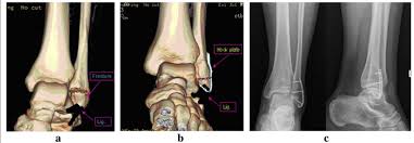 300 x 530 jpeg 55 кб. The Radiographs Of Patients With Lateral Malleolus Avulsion Fracture Download Scientific Diagram