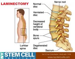 Laminectomy Is Surgery That Creates Space By Removing The Lamina The Back Part Of A Vertebra That Covers Your Spin Healthy Facts Stem Cell Therapy Stem Cells