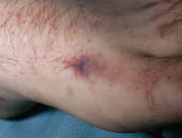 Purpura fulminans is a cutaneous manifestation of disseminated intravascular coagulation. Meningococcal Disease Dermnet Nz