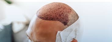 Follicular Unit Extraction (FUE) Hair Transplant in Dubai | HealthHub by  Al-Futtaim Clinics in Dubai | Best Medical Centers in Dubai