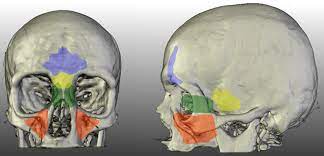 Anatomical Structure Of The Sinuses Red Sinus Maxillaris Yellow Download Scientific Diagram