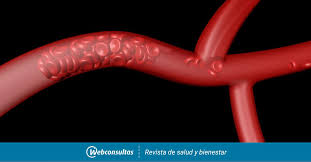 El pronóstico a largo plazo del paciente que ha sufrido un episodio de etv puede complicarse debido a la aparición de trombosis recurrentes, a pesar del tratamiento anticoagulante, y a. Trombosis Venosa Cerebral Que Es Sintomas Y Tratamiento