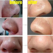 How To Easily Remove Deep Blackheads Alldaychic Deep Blackheads Beauty Hacks Health And Beauty Tips