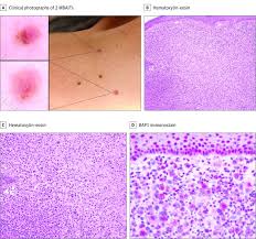 Germline bap1 mutations are associated with a novel cancer syndrome characterized by malignant mesothelioma, uveal melanoma, cutaneous melanoma and mbaits, and possibly by other cancers. Genotypic And Phenotypic Features Of Bap1 Cancer Syndrome A Report Of 8 New Families And Review Of Cases In The Literature Abstract Europe Pmc