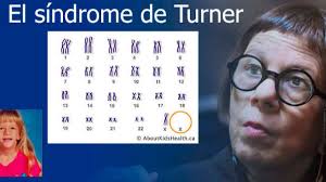 El síndrome de Turner