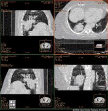 Abdominal ct scans are used to image the organs, tissues and vessels in the abdomen. 4d Ct Scan 4d Medical Imaging Upmc Cancercenter