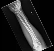 Image result for Galeazzi Sign