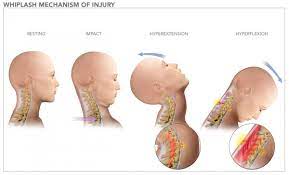 Pin On San Diego Injury Law Center 619 338 8230