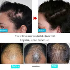 According to research, scalp massage increases hair thickness by stretching the cells of hair follicles. Buy Biotin Hair Growth Kit Led Hair Growth Comb Brush Biotin Hair Regrowth Serum For Hair Loss Scalp Massage Hair Regrowth Brush Treatment For Men And Women Online In Indonesia B08d9gzyt1
