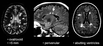 Mri is the most sensitive method for revealing asymptomatic diss … The Use Of Magnetic Resonance Imaging In The Diagnosis And Long Term Management Of Multiple Sclerosis Neurology