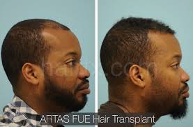 They all have another thing in common besides their thinning hair or bald spots. Ethnic Hair Restoration Dallas Ethnic Hair Surgery Plano Tx