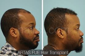 Hair loss causes prevent hair loss how to stop balding natural hair loss treatment male pattern baldness regrow hair hair loss remedies hair restoration hair loss. Ethnic Hair Restoration Dallas Ethnic Hair Surgery Plano Tx