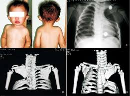Each rib articulates posteriorly with two thoracic vertebrae it assists in inspiration by driving the ribs in the cranial direction.6. Fig A B The Little Girl S Portraits In Front And In Back Showing Download Scientific Diagram
