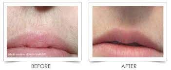 Bleaching any upper lip hair will instantly minimise its appearance on light skin tones. Laser Hair Removal Columbia Laser Skin Center