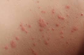 Image result for dermatitis contacta allergica
