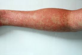 L'intossicazione alimentare è causata dal consumo di alimenti contaminati generalmente. Eruzione Cutanea Sintomi Dermatologia Pazienti It