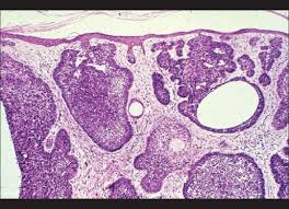 Of ink spot lentigo showing lentiginous hyperplasia of. Pathology Of Eyelid Tumors Abstract Europe Pmc