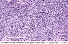Morphologic appearance ranges from epithelioid, sarcomatoid, and biphasic subtypes, but variants with pleomorphic, deciduoid, small, vacuolated, and clear cells have also been described. Pathology Outlines Sarcomatoid Variant