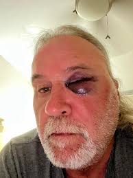 Baseball player's injury was horrifying to watch live