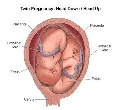 Most breech babies will turn naturally before labour. Breech Birth Wikipedia