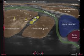 Image result for Superior Trunk Block