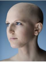 Puva treatment of alopecia areata partialis, totalis and universalis: Alopecia Totalis My Hair Doctor Prescription Haircare