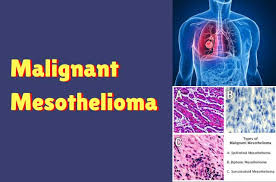 Pleural mesothelioma makes up approximately 75 percent of all mesothelioma cases, meaning specialists have more opportunities to develop new treatments each year. Malignant Mesothelioma The Cancer Of The Mesothelial Cells