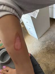 Home remedies for treating minor burns