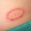 Penyakit kudis buta atau scabies berpunca dari hama. 1