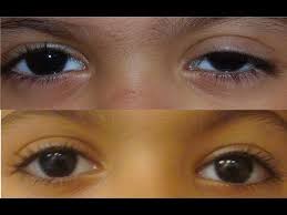 134 How To Fix A Lazy Eye Youtube Lazy Eye Exercises Lazy Eye Fix Eye Exercises