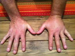 Once Bitten Twice Shy Taking The Sting Out Of Yellow Jackets Survival Sherpa