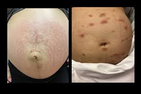 Image result for pruritic urticarial papules and plaques of pregnancy