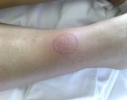 Image result for erythema nodosum