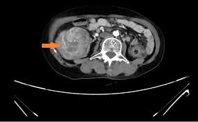 Image result for Adult Intussusception