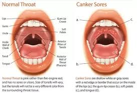 Image result for Mouth ulcers roof of mouth