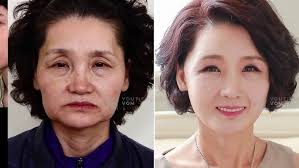 CIRUGIA PLASTICA PARA SONRISA PERMANENTE