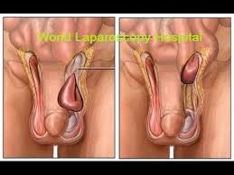 Laparoscopic Inguinal Hernia Repair Ipom With Dual Mesh Hernia Repair Repair Dual