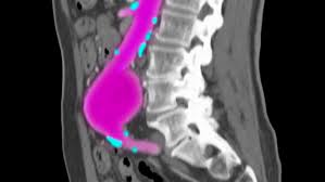 It won't make all or most of the blocks around you disappear making it difficult to function. Diagnostic X Ray Procedures Conditions Treatments Ut Southwestern Medical Center