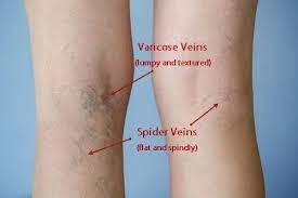 Best Compression Stockings For Varicose Veins In Malaysia Mommy Lynn