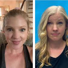 nofilter coming RIGHT at ya! I went for my follow up with  @dermatologypractice_nc and guys