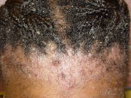 Common methods used for treating dandruff. Dry Itchy Scalp Natural Hair Remedies Treatment 4c Black Hair
