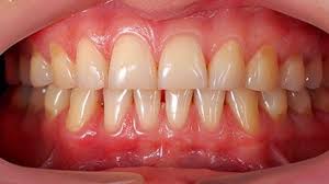 You have the power to take your gum health into your own hands. Is Age The Cause Of Receding Gums Bbc Future