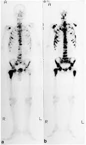 Introduction to prostate cancer • prostate cancer forms in the cells of the prostate gland. Serial Changes Of Bone Metastases In A Patient With Prostate Cancer Download Scientific Diagram