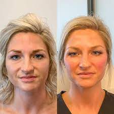 Definitive guide on cheek augmentation with fillers, including the procedure overview, benefits, risks, recovery, before & after photos, costs, and more. How Cheek Filler Makes You Look Younger Boss Gal Beauty Bar