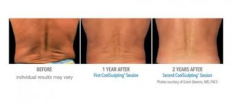 Check spelling or type a new query. Coolsculpting Before And After Photos Center For Medical Aesthetics