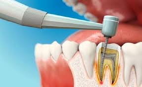 Răng đã lấy tủy tồn tại được bao lâu? Có nên lấy tủy răng hay không?