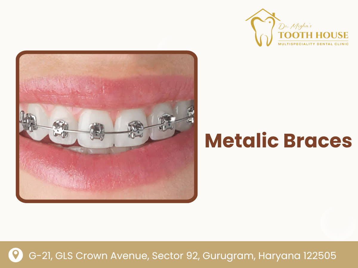 Metalic Braces product image
