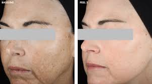 Chemical Peels Swansea