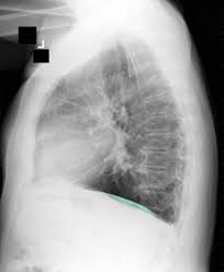 Here we present cxr from 64 year old hispanic male who was diagnosed with advanced mesothelioma; Asbestosis Knowledge Amboss