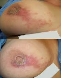 This type of cancer is rare, but needs to be evaluated quickly. Cureus Systemic Lupus Erythematosus Is Not Necessarily A Contraindication To Adjuvant Breast Radiation Therapy
